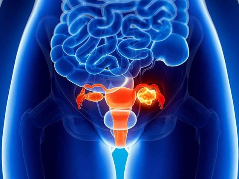 cfui-Urologic-Cancer-