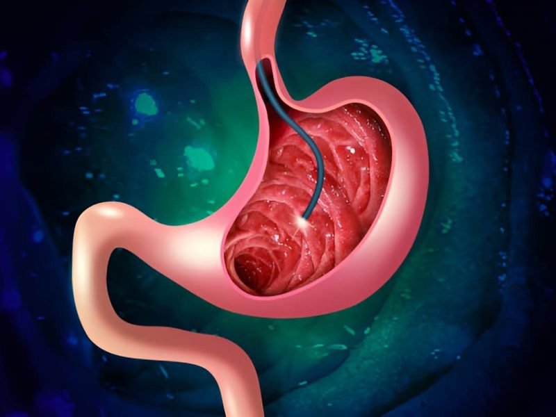 Digestive endoscopy or gastroscopy. Performing a gastroscopy procedure. Diagnostics of gastric diseases. Stomach health. Medical concept